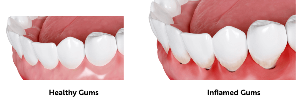 Comparison image between healthy gums and inflamed gums
